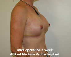 plastic-surgery-breast-augmentation